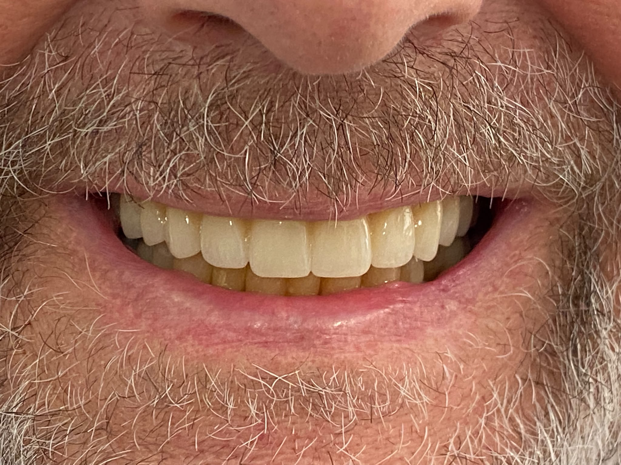 Same patient's smile after full-arch dental implant treatment, showing a complete fixed arch of teeth
