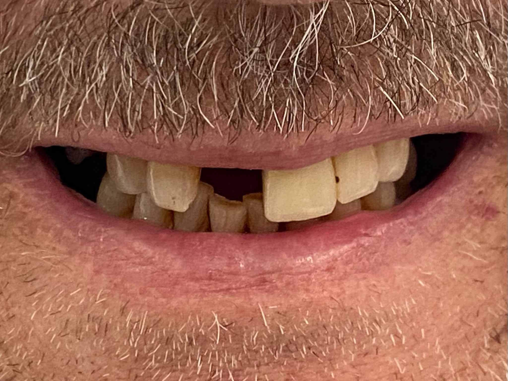Patient's smile before full-arch dental implant treatment, showing worn and damaged teeth